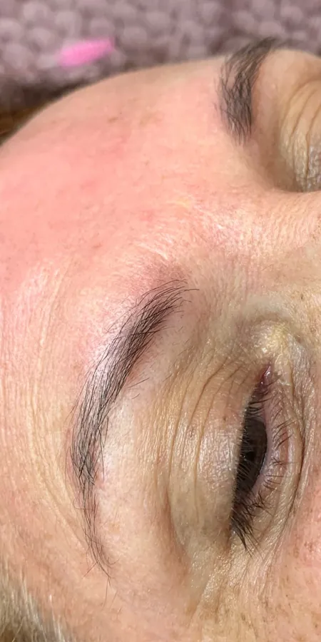 Caso 2, depois: a sobrancelha com os pelos naturais, sem o bloco de pigmento.